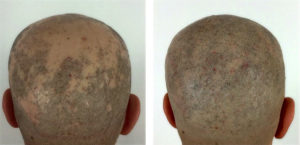 Alopecia Areata totalis