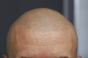 Follicraft scalp micropigmentation