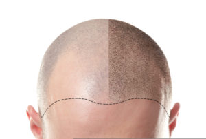 Follicraft scalp micropigmentation before after