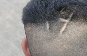 Scarring Alopecia Injury Scars