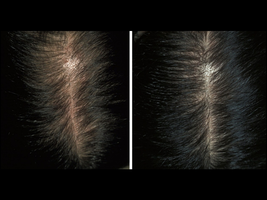 Female pattern Hair loss