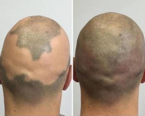 alopecia benefit from scalp micropigmentation