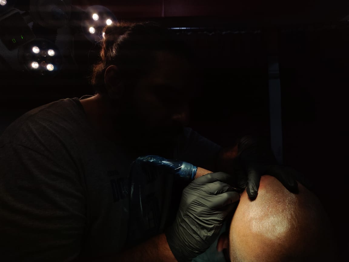 FUT/ FUE Transplant Scar