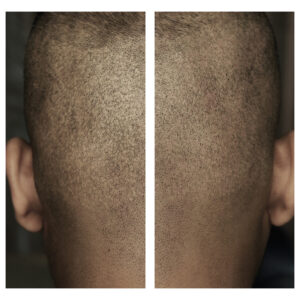 Follicraft scalp micropigmentation FUE hair transplant scar coverup