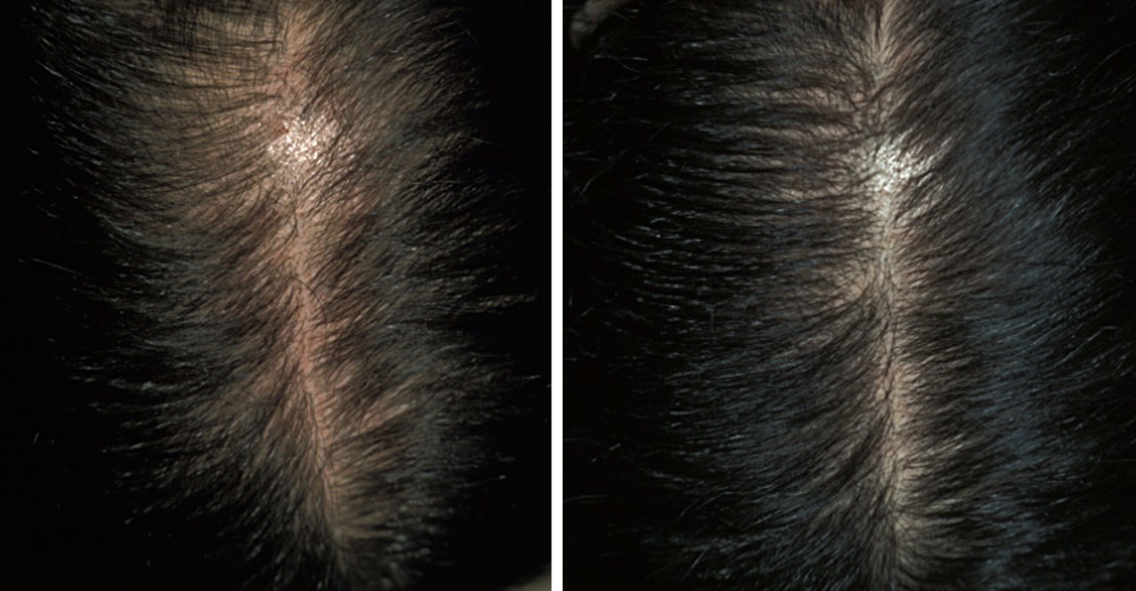 Density treatment for female pattern diffused hair loss