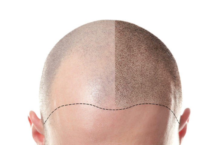 Follicraft scalp micropigmentation before after